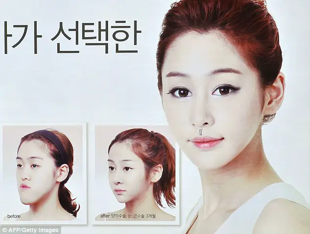 Jaw surgery in Korea, plastic surgery in Korea